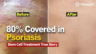 Stem cell skin disease treatment interview with smartMcell2